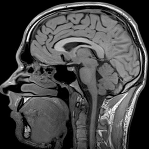 the villages mri head|Brain MRI .